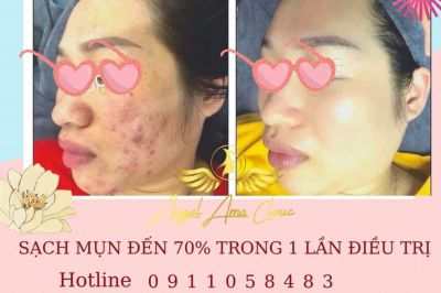 D ch v i u tr laser fractional CO2 Einxel plus Las