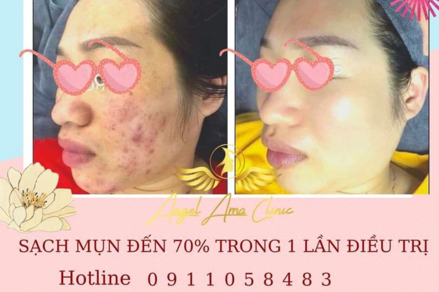 D ch v i u tr laser fractional CO2 Einxel plus Las