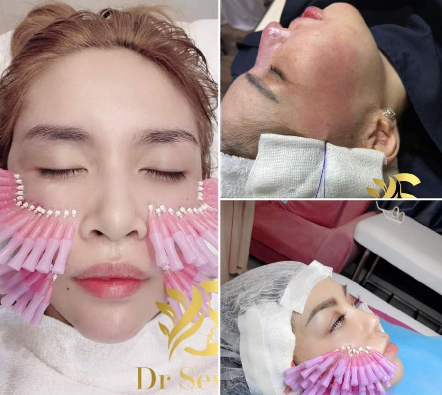 D ch v tr h? a n? ng c hifu RF