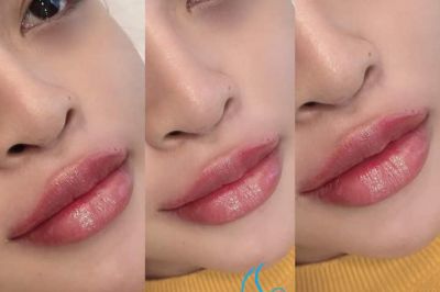 D ch v m? i v? ti? m filler botox