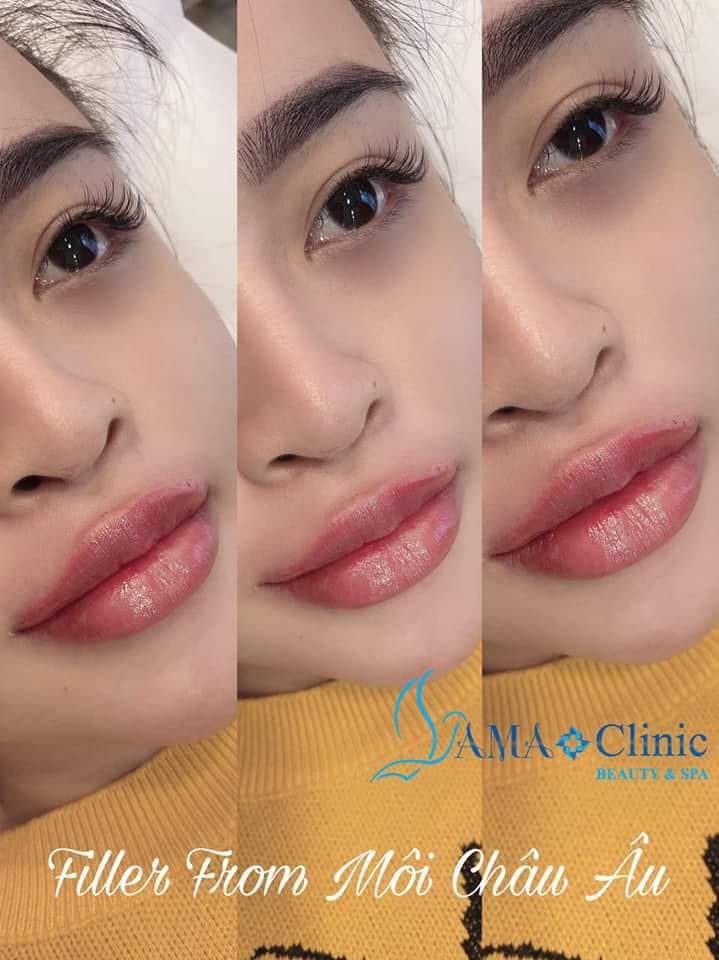 D ch v m? i v? ti? m filler botox